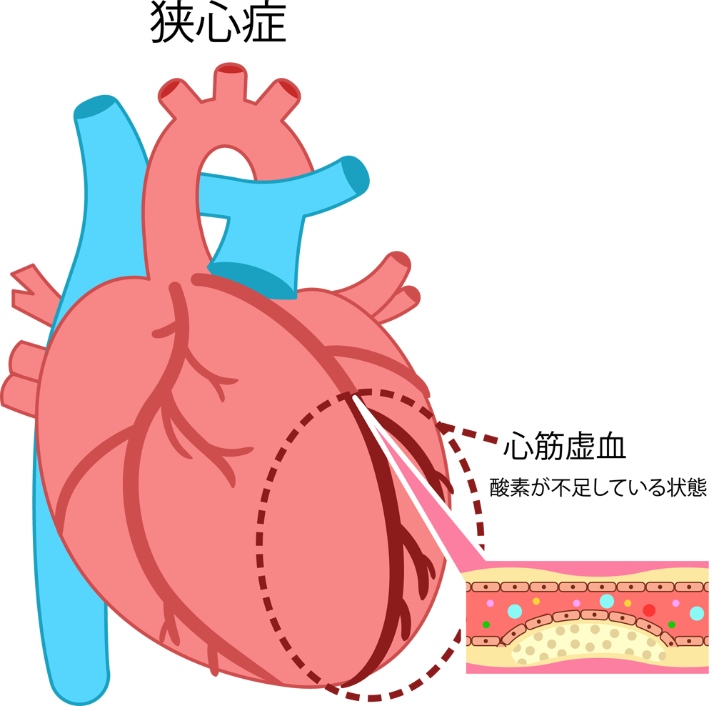 血管が狭くなる「狭心症」