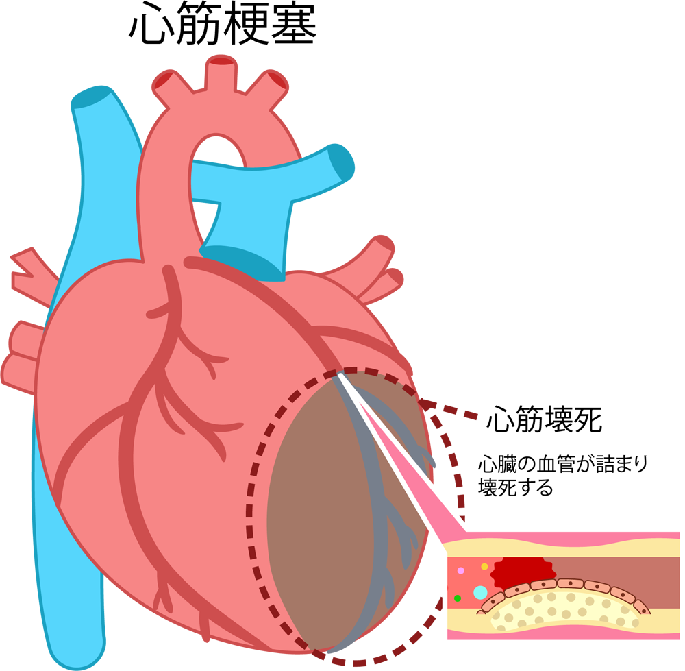 血管が詰まる「心筋梗塞」