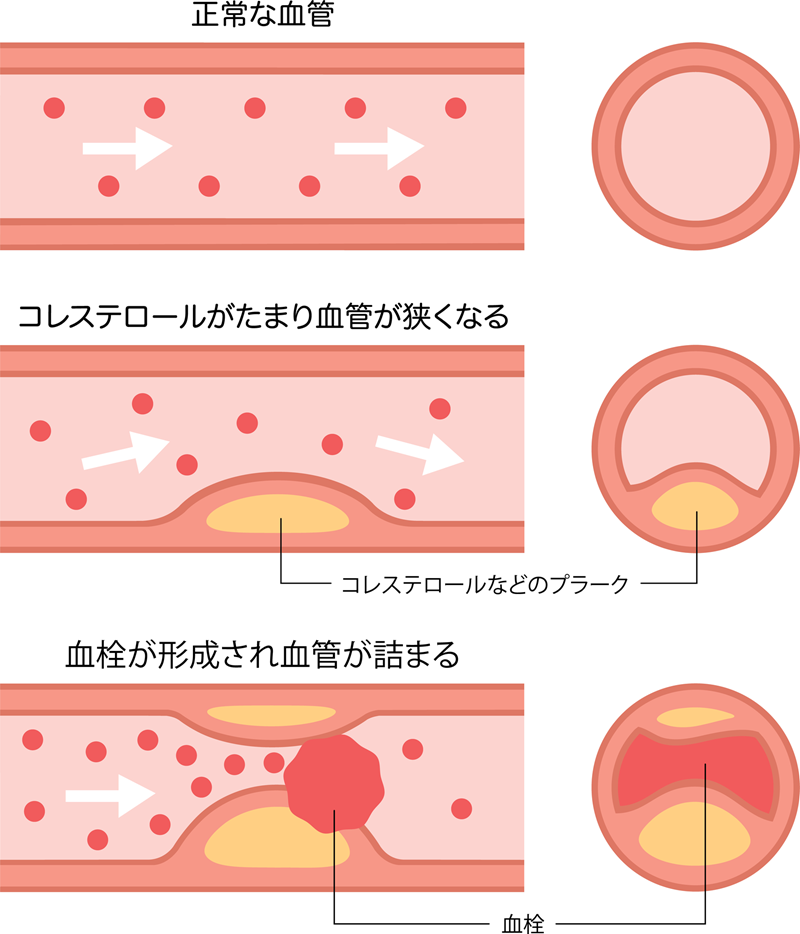 狭心症・心筋梗塞の原因