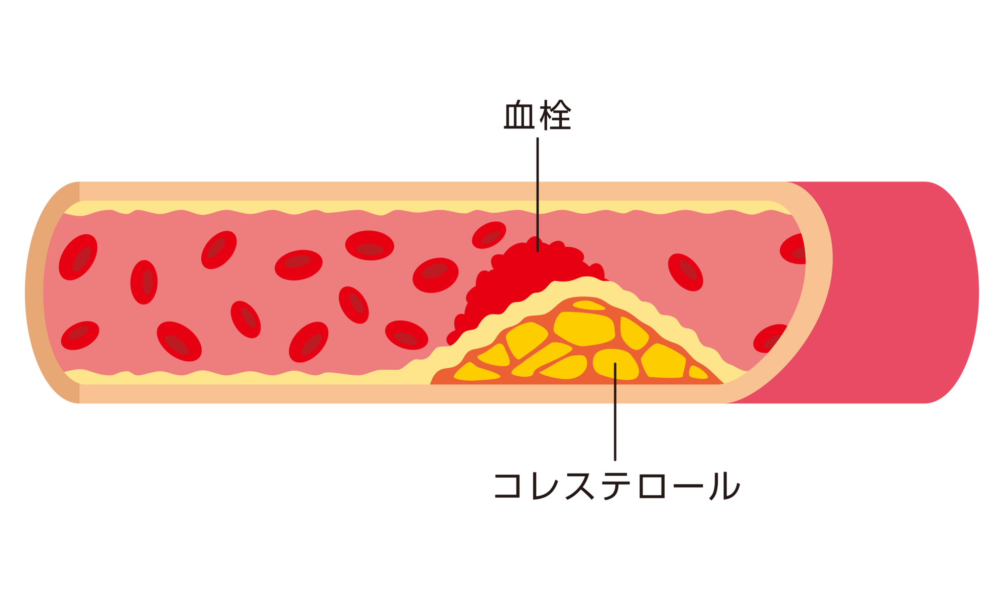 脂質異常症を治療しないとどうなる？