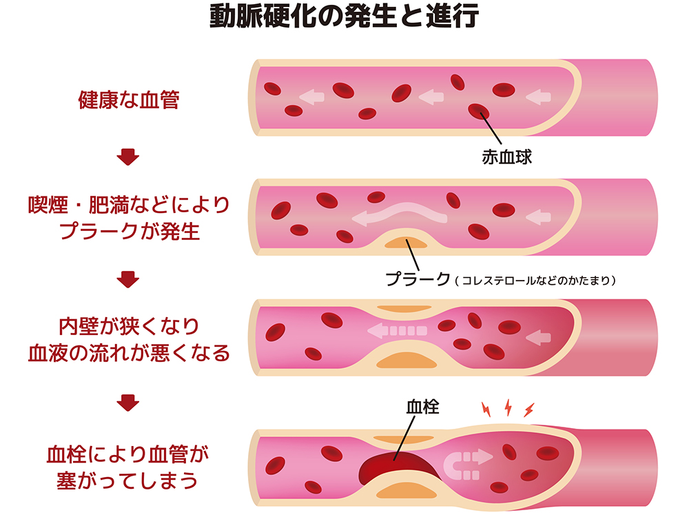 肥満と生活習慣病