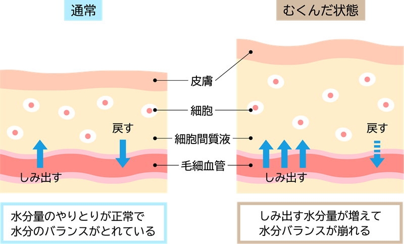 むくみの症状チェック